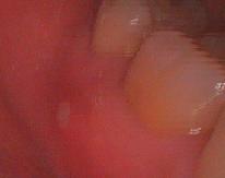 歯肉の咬傷